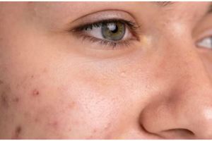 Cara hilangkan pigmentasi akibat penuaan dini ini cuma pakai toner dari 1 buah, bikin kulit glowup