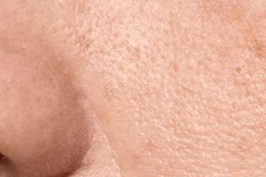 Trik mengecilkan pori-pori wajah ini cuma butuh 1 bumbu masakan, bantu atasi minyak berlebih