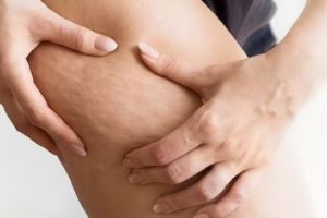 Bukan pakai salep, begini trik pudarkan stretch mark membandel pakai 1 jenis umbi-umbian