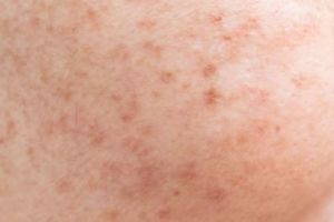 Wajah kinclong dan mulus, begini trik hempaskan flek hitam pakai toner dari 1 jenis tanaman herbal