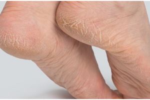 Auto kenyal seperti kulit bayi, begini cara atasi tumit pecah-pecah hanya pakai 1 jenis bunga