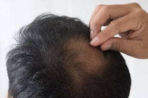 Bukan pakai hair tonic, begini trik menumbuhkan kembali rambut botak pakai 1 jenis biji-bijian