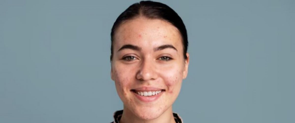 Tak perlu serum antiacne, ini trik mengatasi jerawat pakai scrub