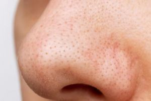 Bukan pakai pore pack, ini trik hempaskan komedo hitam dan putih pakai scrub dari 1 jenis buah