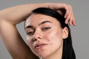 Bukan pakai skincare mahal, ini cara memudarkan bekas jerawat pakai 1 jenis olahan susu