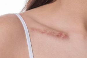 Bikin kulit cerah dan mulus, ini trik menghilangkan bekas luka pakai scrub dari 1 bahan minuman