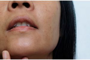 Hempaskan noda, begini trik menghilangkan flek hitam hanya pakai 1 jenis kulit buah