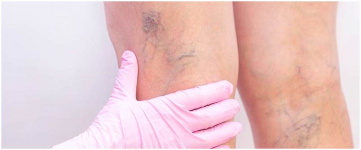 Nggak perlu ke dokter, begini trik atasi varises di kaki hanya pa