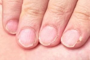 Efeknya terlihat dalam 2 minggu, begini cara mengatasi kuku rusak akibat kuteks pakai 1 jenis minyak