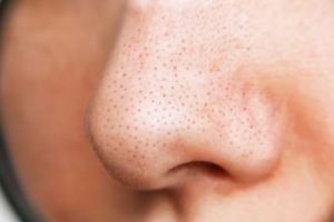 Wajah lebih mulus, begini trik hilangkan komedo hitam di hidung pakai scrub dari 2 bahan pemanis