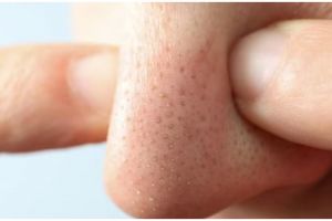 Pori-pori jadi bersih, begini trik hilangkan komedo di dahi hanya pakai 2 jenis rempah