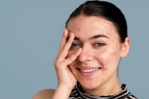 Jadi mulus dan bebas komedo, ini trik merawat wajah mudah berjerawat pakai 1 jenis bahan makanan