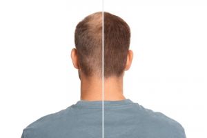 Penderita kebotakan wajib coba, ini cara simpel bikin rambut kembali lebat pakai 1 bahan masak