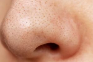 Nggak sakit dan tak perlu pore pack, begini trik hilangkan komedo hitam di hidung pakai 1 jenis rempah