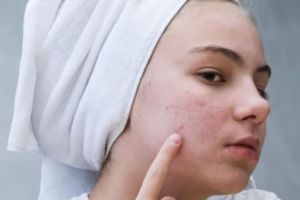 Bersih optimal bak pakai face wash pasaran, ini cara membuat acne cleansing dari 1 bahan pemanis