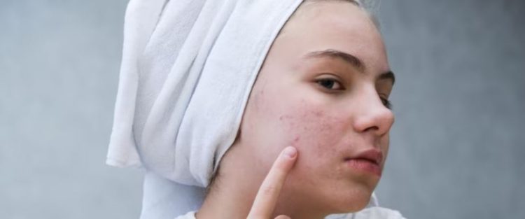 Bersih optimal bak pakai face wash pasaran, ini cara membuat acne