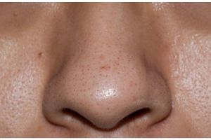 Bikin segar dan pori-pori rapat, ini cara hempas sebum berlebih pada kulit wajah pakai 2 jenis buah