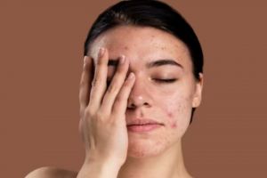 Cegah jerawat dan auto glowing, ini trik membuat serum untuk wajah berminyak pakai 1 jenis buah