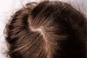 Nggak perlu beli hair serum mahal, ini trik atasi kerontokan dan ketombe pakai 2 jenis rempah