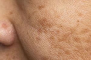 Hasil terlihat dalam 5 menit, ini trik atasi noda hiperpigmentasi wajah pakai 1 jenis umbi-umbian