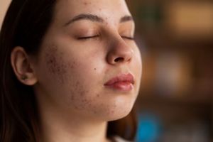 Jangan dibuang, ini trik bikin serum dari 1 jenis kulit buah untuk hempas spot hitam dan kusam