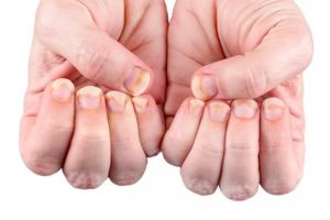 Cara mudah bikin kuku nggak gampang patah pakai 2 jenis minyak, sehat tanpa perlu manicure