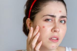 Flawless tanpa komedo dan jerawat, ini cara mengurangi minyak pada wajah pakai 1 sumber protein