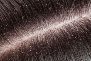 Atasi gatal dan kulit kepala bersisik, begini trik hilangkan ketombe kering pakai 1 jenis buah