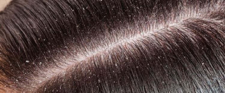 Atasi gatal dan kulit kepala bersisik, begini trik hilangkan ketombe kering pakai 1 jenis buah