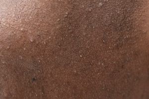 Trik mengatasi kulit stroberi pada badan pakai 1 bubuk minuman, jadi mulus nggak pakai lama