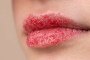Pinggiran gelap auto pink alami dalam 3 hari, ini trik cerahkan bibir pakai scrub dari 2 bahan pemanis