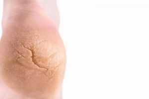 Jadi lembut bak kulit bayi, ini trik hempaskan tumit kaki yang pecah-pecah pakai 1 peralatan rumah