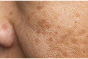 Cara mudah hilangkan flek hitam akibat melasma pakai 1 jenis tepung, bikin warna kulit kembali merata