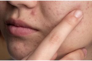 Hilang tanpa bekas, begini trik atasi jerawat meradang hanya pakai 1 jenis karbohidrat