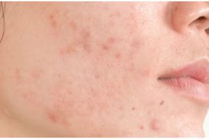 Cara mudah pudarkan pigmentasi pakai krim dari 1 jenis kacang-kacangan, bikin warna kulit kembali rata