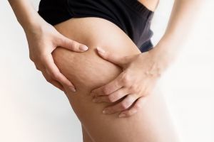 Trik pudarkan stretch marks di perut dan paha pakai 1 ekstrak kacang, kulit jadi mulus kembali