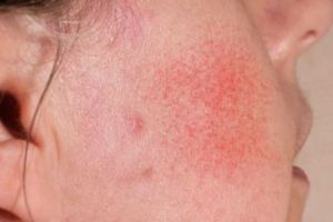 Bantu atasi perih akibat iritasi, ini cara menenangkan wajah kemerahan pakai 1 jenis bahan minuman