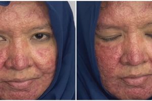 Punya kulit gradakan karena jerawat, wanita ini dirias MUA jadi manten Sunda manglingi berwajah mulus