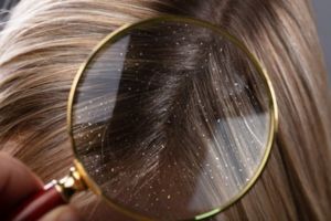Trik enyahkan masalah ketombe di rambut pakai 2 jenis daun herbal, kepala jadi bebas gatal