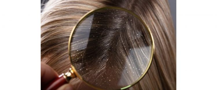 Trik enyahkan masalah ketombe di rambut pakai 2 jenis daun herbal, kepala jadi bebas gatal