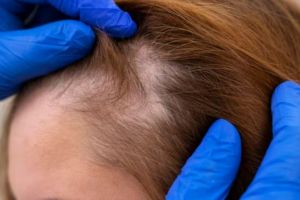 Tak hanya pakai hair tonic, ini trik menumbuhkan rambut pitak pakai 2 jenis minyak