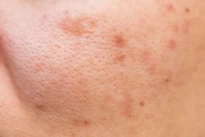 Tak hanya dengan clay mask, begini cara mengecilkan pori-pori wajah pakai masker dari 1 jenis kayu