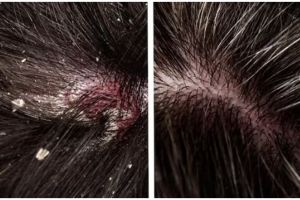 Tak perlu minyak kelapa, ini trik hilangkan ketombe kering di kulit kepala hanya pakai 1 jenis tanaman