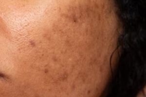 Tak perlu pakai kunyit, ini trik menghilangkan flek hitam membandel hanya pakai 1 jenis bahan pemanis