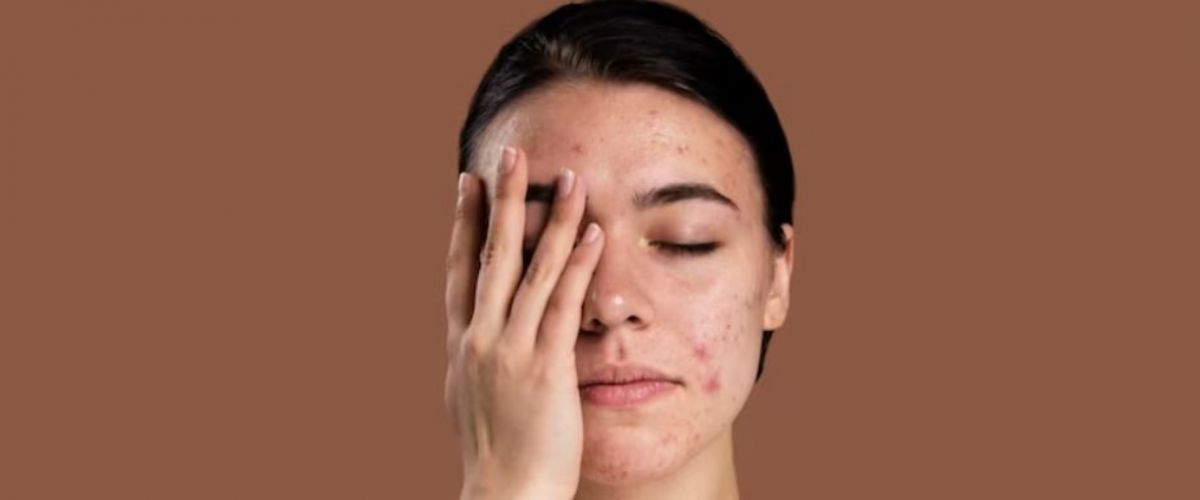 Tak kalah efektif dari kunyit, ini trik mengatasi jerawat dan bek