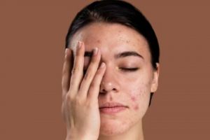 Tak kalah efektif dari kunyit, ini trik mengatasi jerawat dan bekasnya pakai masker dari 1 jenis daun