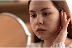 Cara atasi jerawat meradang pakai facial wash dari 1 jenis bunga, bikin kulit tenang dan antiiritasi