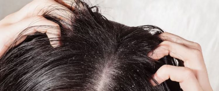 Tak perlu pakai kopi, begini trik hilangkan ketombe dan kulit kepala gatal dengan 1 jenis olahan susu