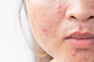 Tak hanya kunyit, ini trik hilangkan jerawat agar tidak berbekas pakai 2 jenis daun herbal