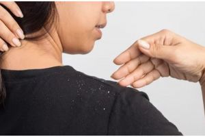 Modal di bawah Rp 30 ribu, ini cara atasi ketombe basah pakai hair oil dari 2 jenis tanaman